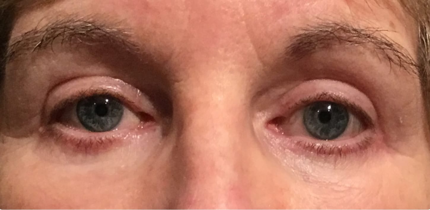 After Image: Blepharoplasty All 4 Eyelids - front