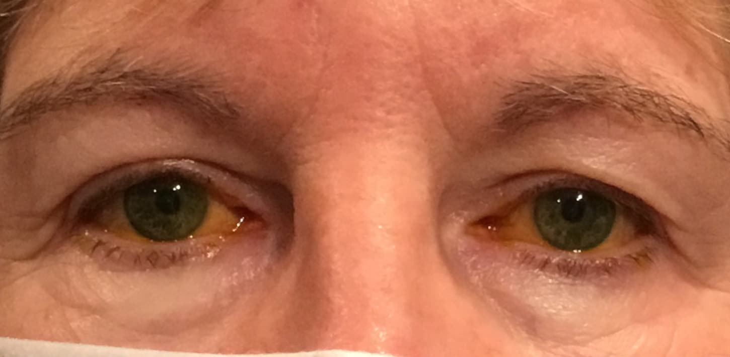 Before Image: Blepharoplasty All 4 Eyelids - front