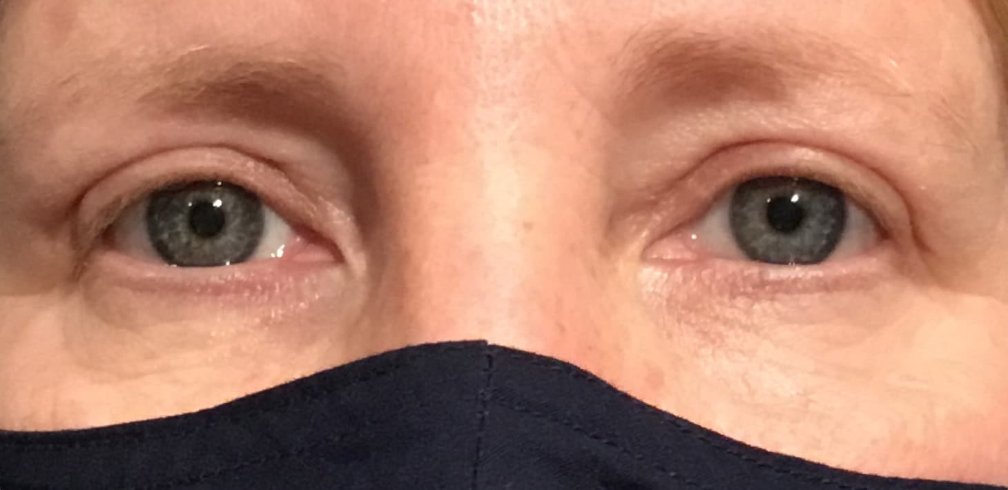After Image: Upper Eyelid Blepharoplasty - front