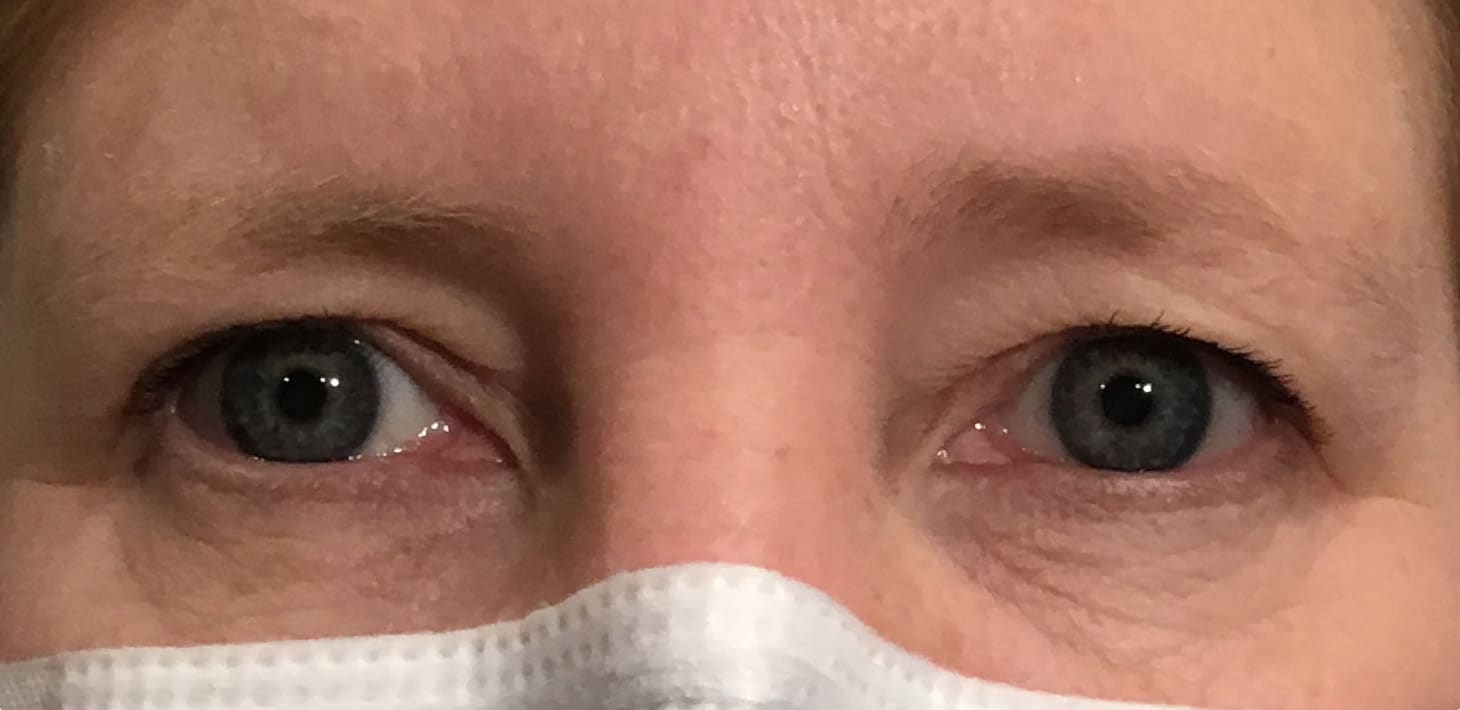 Before Image: Upper Eyelid Blepharoplasty - front