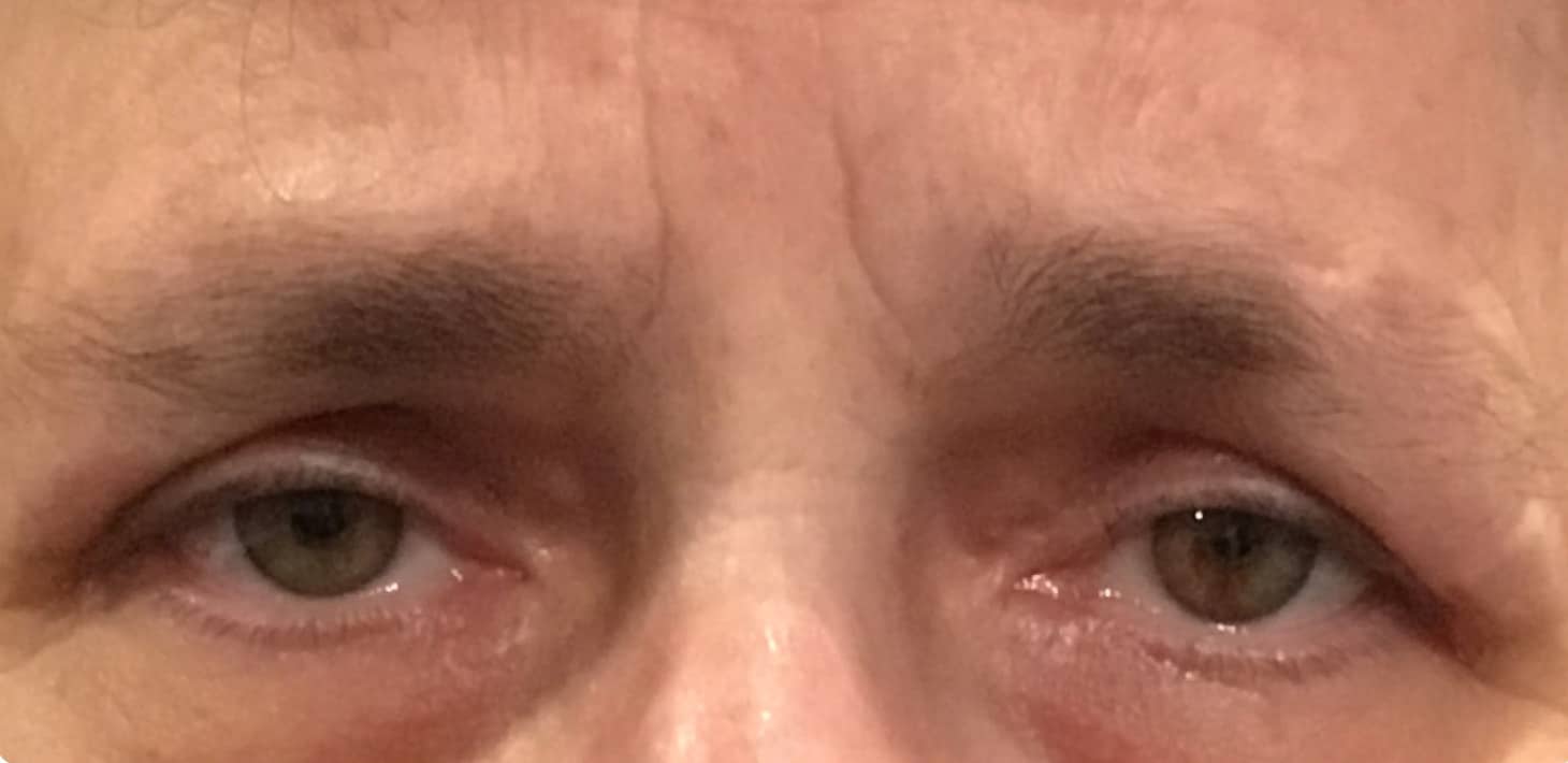 After Image: Upper Eyelid Blepharoplasty - front