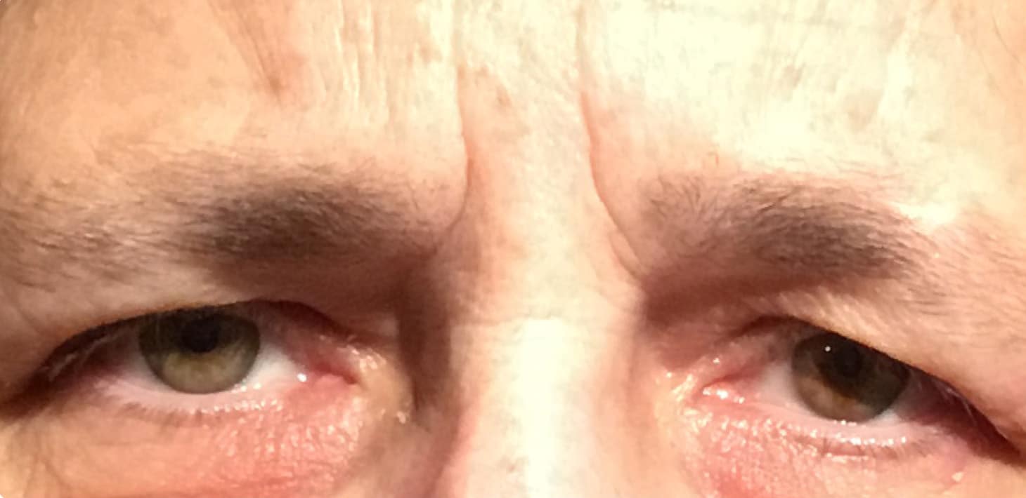 Before Image: Upper Eyelid Blepharoplasty - front