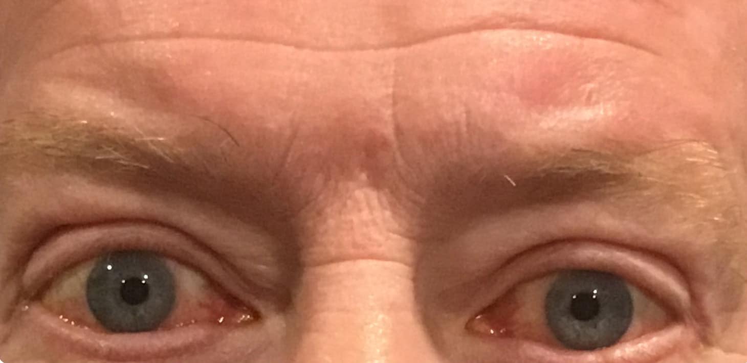 After Image: Upper Eyelid Blepharoplasty - front