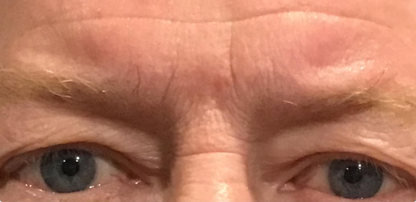 Before Image: Upper Eyelid Blepharoplasty - front