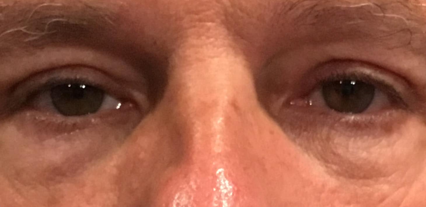 After Image: Upper Eyelid Blepharoplasty - front