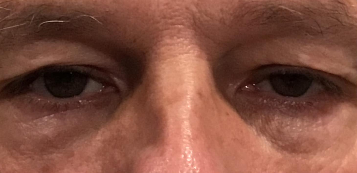 Before Image: Upper Eyelid Blepharoplasty - front