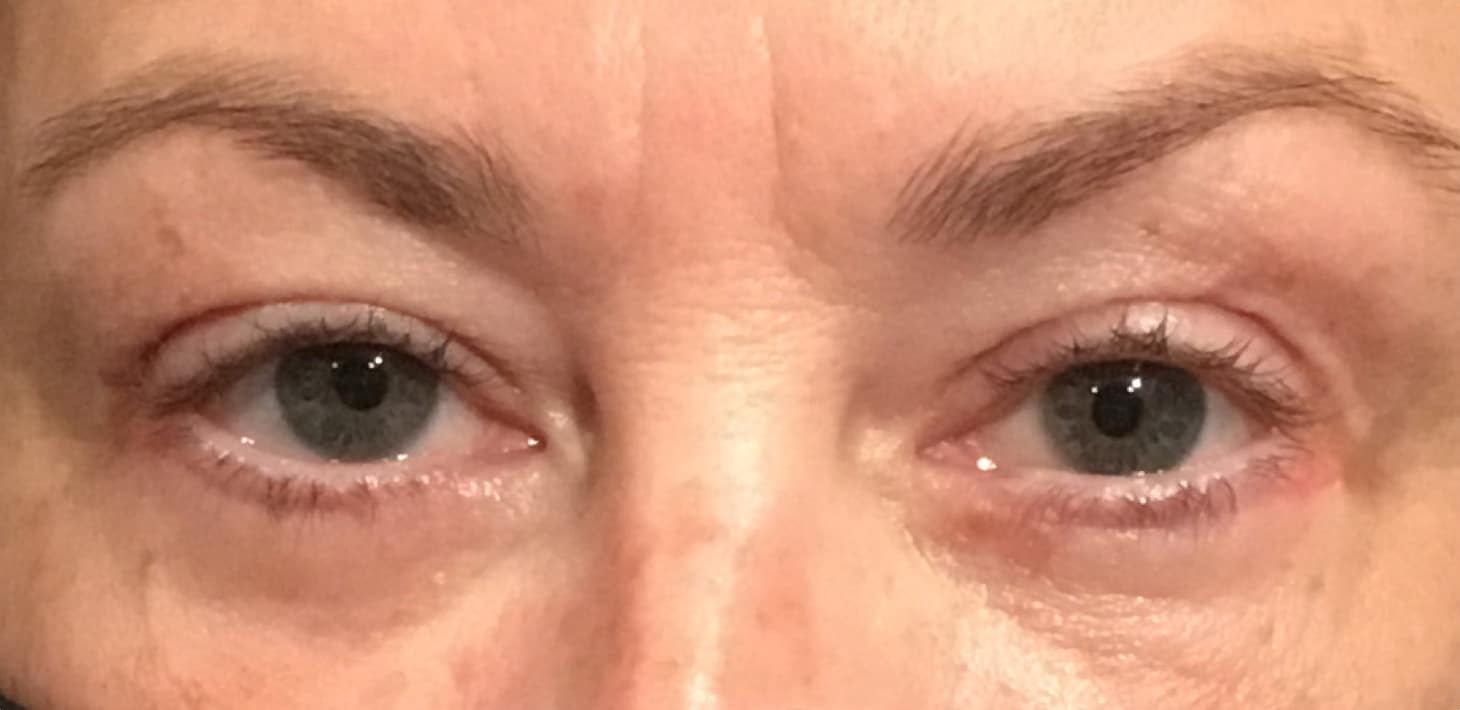 After Image: Cosmetic Lower Eyelid Blepharoplasty - front