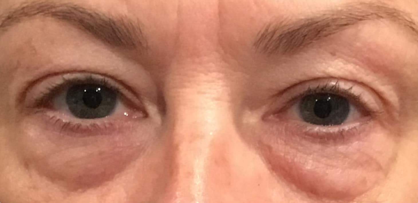 Before Image: Cosmetic Lower Eyelid Blepharoplasty - front