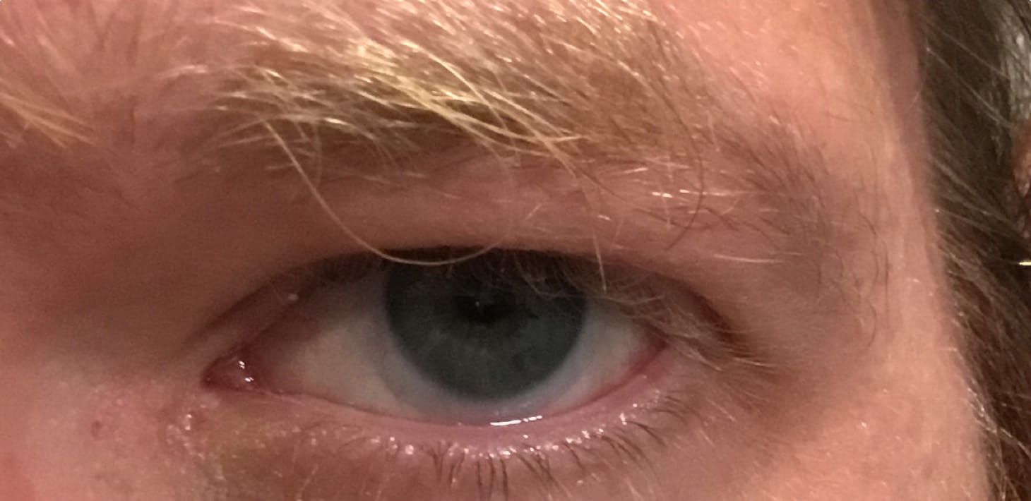 After Image: Eyelid Lesion Removal - front