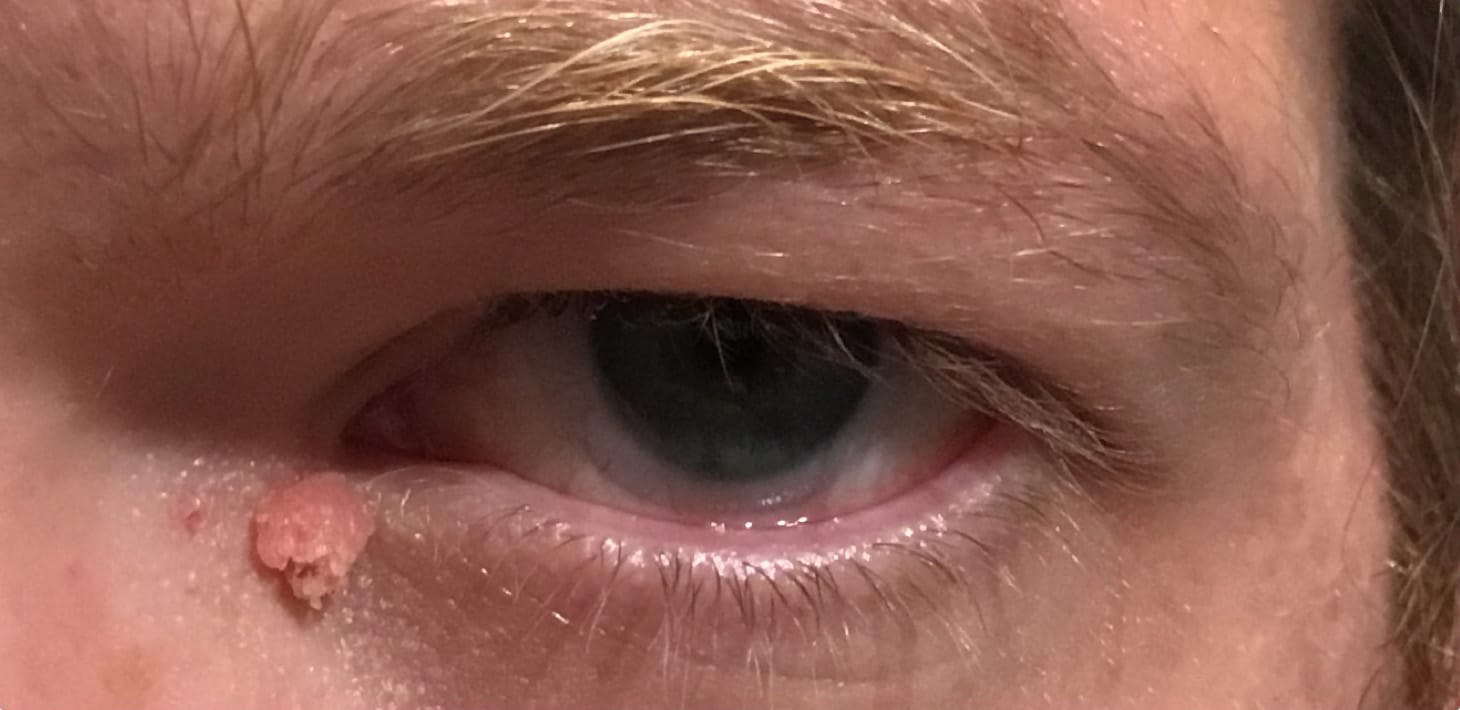 Before Image: Eyelid Lesion Removal - front