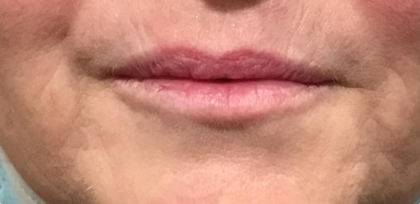 After Image: Lip Filler - front