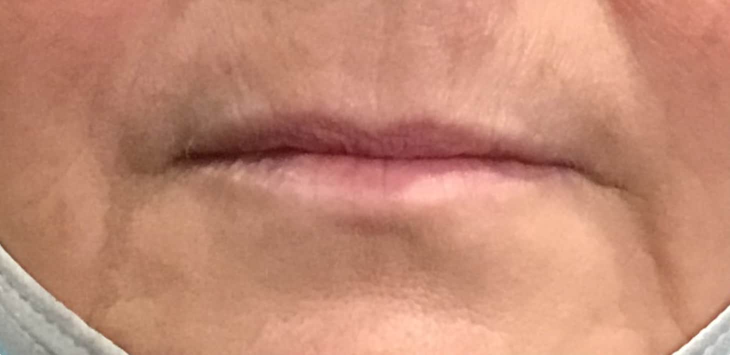 Before Image: Lip Filler - front