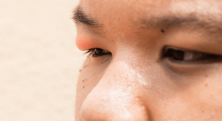 Reasons Why Your Eyelid is Swollen 65b8041b7f24b.png